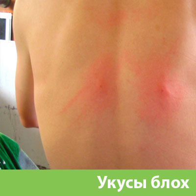 Укусы блох в Великом Новгороде