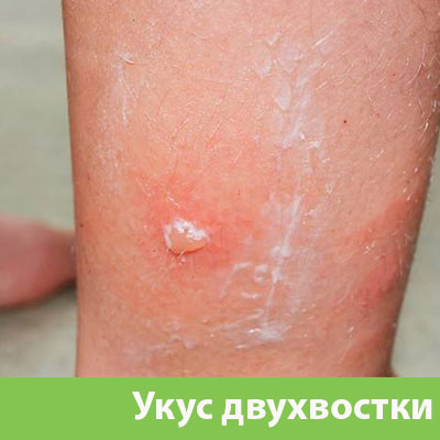 Укус двухвостки в Великом Новгороде
