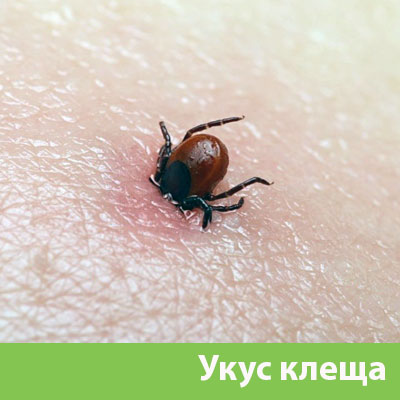 Укус клеща в Великом Новгороде