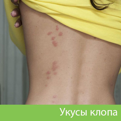 Профессиональное уничтожение клопов в Великом Новгороде